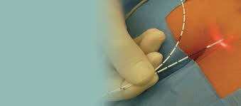 Skilled surgeons for pilonidal cyst treatment with laser in Tehran
